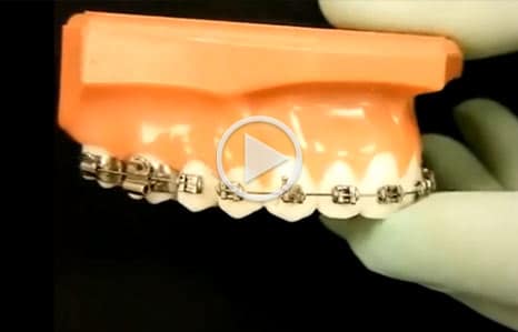 Emergency Care Video Sirius Orthodontics in Syracuse, Liverpool, Baldwinsville, and Geneva, NY