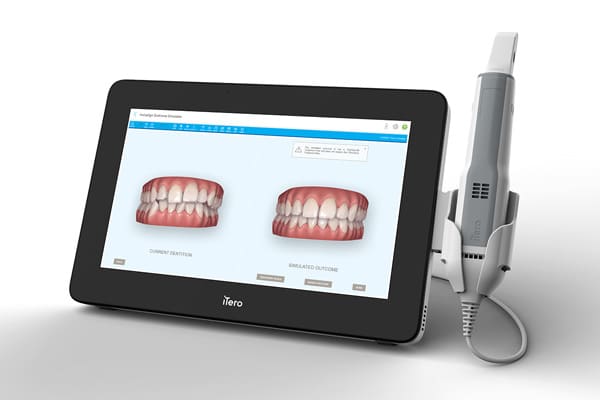Digital impressions Sirius Orthodontics in Syracuse, Liverpool, Baldwinsville, and Geneva, NY